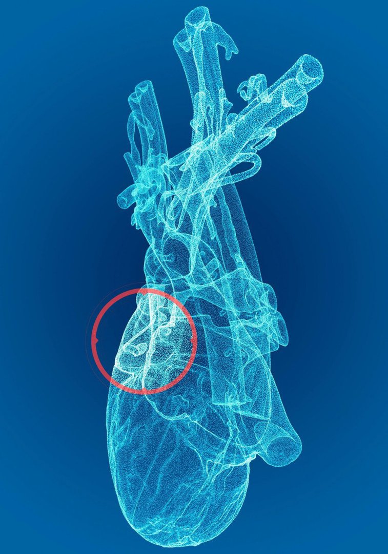 Imaginea articolului Tehnologia 3D poate salva mii de vieţi. HeartFlow ajută pacienţii să fie diagnosticaţi şi trataţi de cinci ori mai rapid