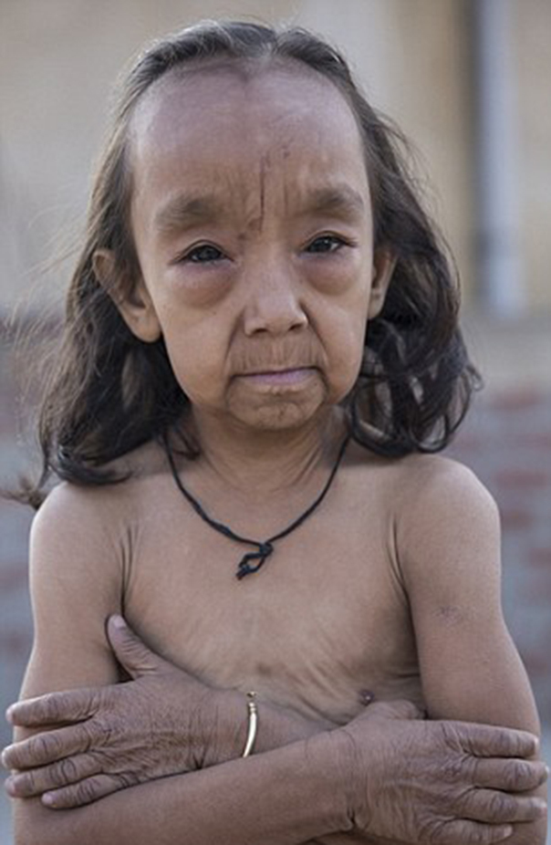 Progeria: Vezi GALERIA FOTO cu boala necruţătoare | Boli şi tratamente, Sănătate | dancewithmestudio.ro