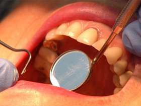 Igiena dentară necorespunzătoare ar putea avea legătură cu bolile de inimă