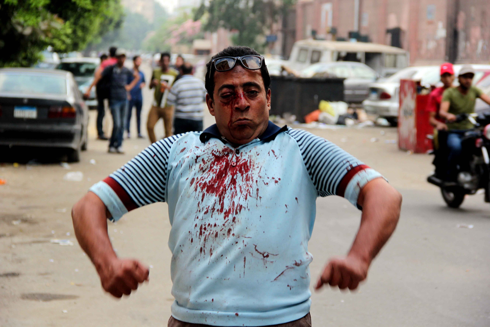 Un protestatar rănit reacţionează în timpul luptelor de stradă dintre membrii Fraţiei Musulmane (Muslim Brotherhood) şi suporterii preşedintelui Mohamed Morsi, în faţa Universităţii Cairo din Egipt, miercuri, 3 iulie 2013. 
