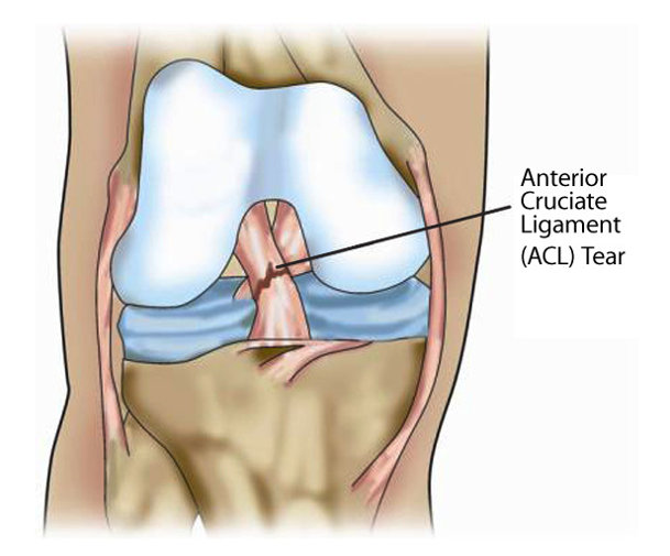 Întărirea ligamentului genunchiului după accidentare, Care sunt primele masuri care trebuie luate?