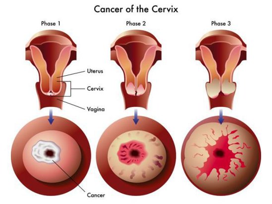 cancer genital feminin simptome