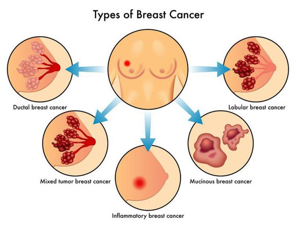 simptome cancer mamar femei