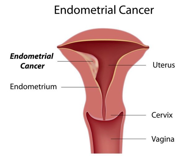 simptome cancer de endometru)