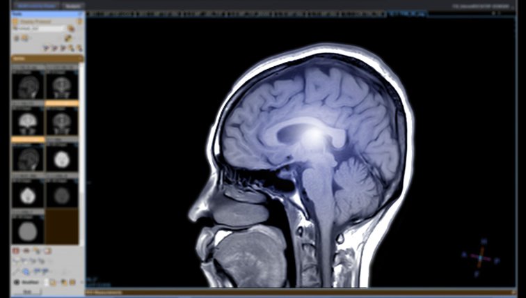 Imaginea articolului Copiii învaţă despre accidentul vascular cerebral, pentru a-şi salva bunicii. Trei simptome care pot prevesti un AVC