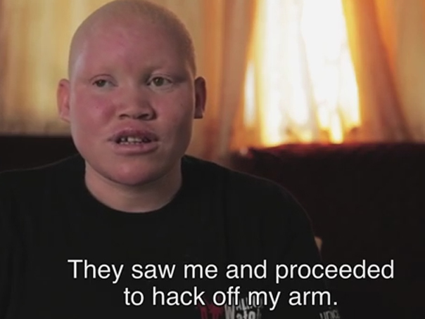 Imaginea articolului Oamenii cu albinism, ucişi în Tanzania pentru vrăjitorie. Mărturiile dramatice ale victimelor - VIDEO