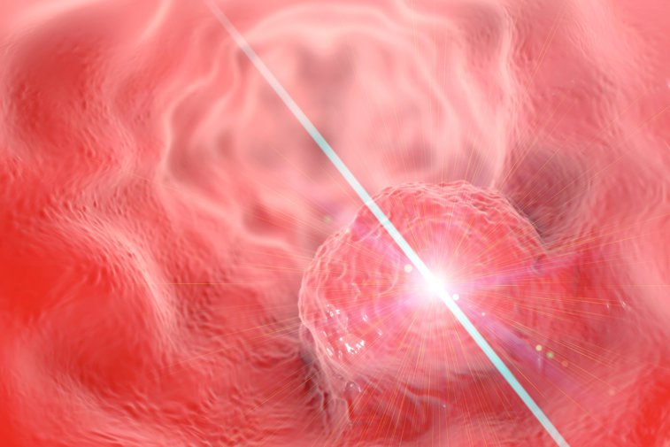 Imaginea articolului Laserul minune care îndepărtează în totalitate cancerul. Când va fi gata