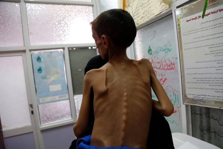 Imaginea articolului Criză umanitară în Yemen: peste 13 milioane de oameni suferă de foamete