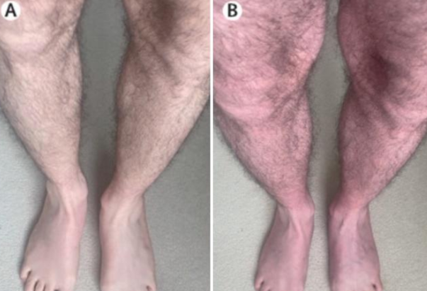 Imaginea articolului „Sindromul” ciudat al picioarelor înnegrite cu care un tânăr s-a prezentat la medic

