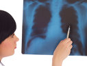 Imaginea articolului Cancerul pulmonar ameninţă şi nefumătorii. Vinovat este radonul, o substanţă radioactivă prezentă în sol