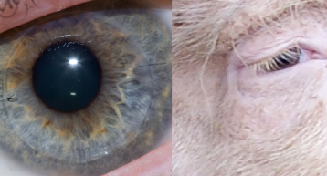 Un implant ocular revoluţionar din piele de porc a redat vederea la 14 nevăzători