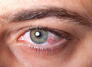 albe roșii ale ochilor care afectează vederea