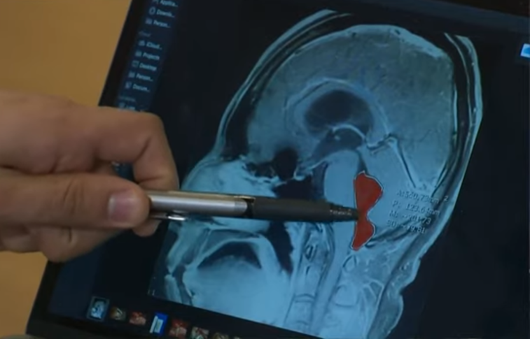 Imaginea articolului Un bărbat avea dureri mari de cap de câteva luni, iar la un moment dat a leşinat. Medicii au făcut o descoperire terifiantă în craniul lui | VIDEO