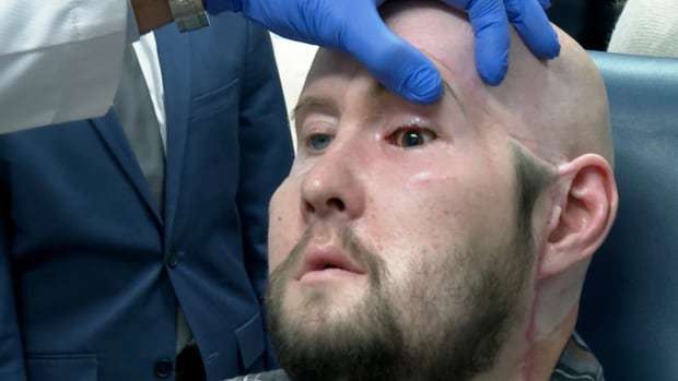 Imaginea articolului Premieră medicală: Chirurgii au efectuat primul transplant de glob ocular uman din lume la New York