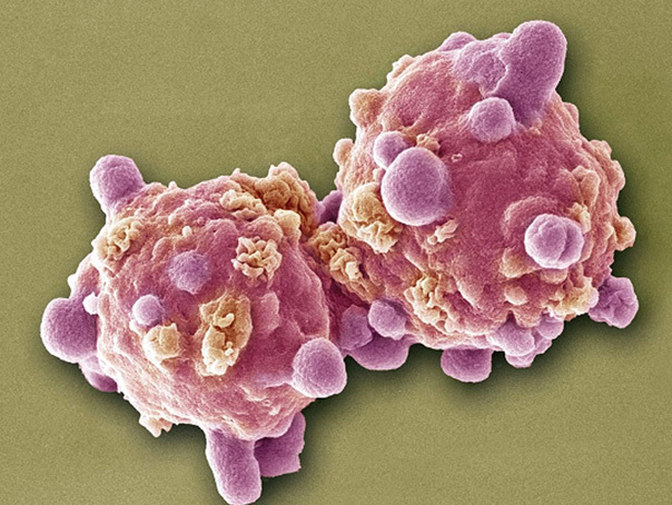 Imaginea articolului SFATURILE experţilor pentru a preveni apariţia cancerului