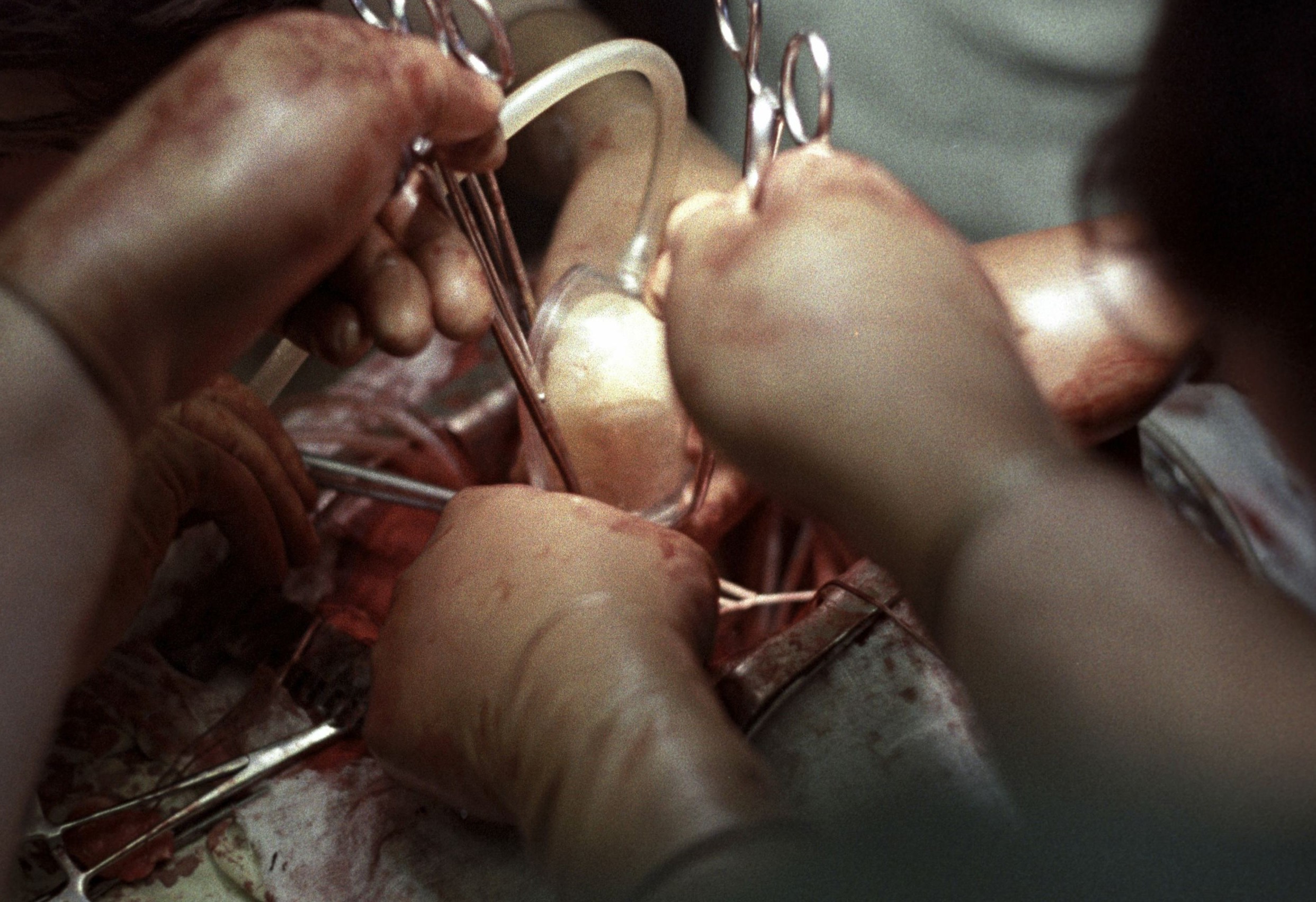 Premieră medicală: A fost realizat primul transplant de inimă de la un donator mort